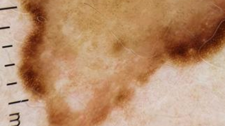 immagine 3 di Quando e perché un neo si trasforma in melanoma
