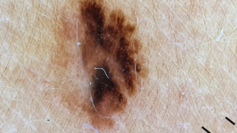 immagine 1 di Quando e perché un neo si trasforma in melanoma