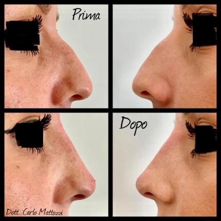 foto quadrupla prima e dopo rinofiller naso donne, pazienti Dr. Mattozzi