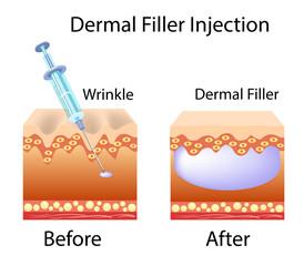 Dermal Filler Injection (before and after)