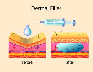 Dermal Filler (before and after)