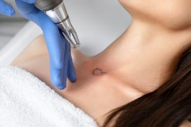 Rimozione Tatuaggio Permanente col Laser