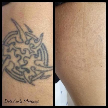 prima e dopo Rimozione tatuaggio spalla dr Carlo Mattozzi