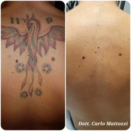 prima e dopo Rimozione tatuaggio schiena dr Carlo Mattozzi