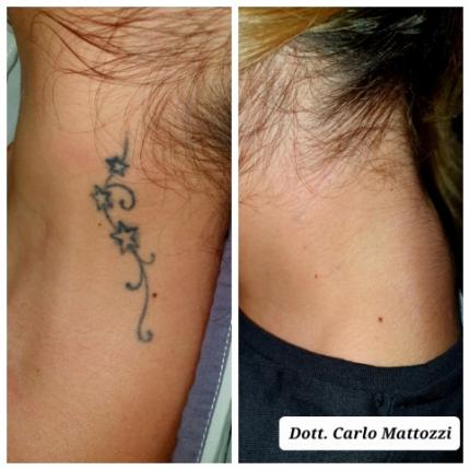 prima e dopo Rimozione tatuaggio collo donna dr Carlo Mattozzi