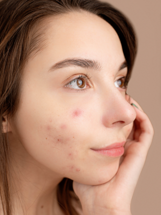 acne giovanile che si manifesta sul viso durante l'adolescenza