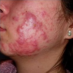 acne molto grave curata dal dott. Mattozzi fase 1