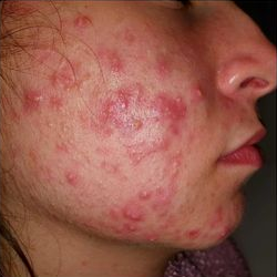 acne molto grave curata dal dott. Mattozzi fase 2