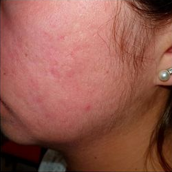 acne molto grave curata dal dott. Mattozzi fase 3