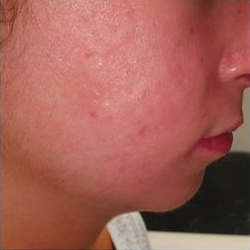 acne molto grave curata dal dott. Mattozzi fase 4