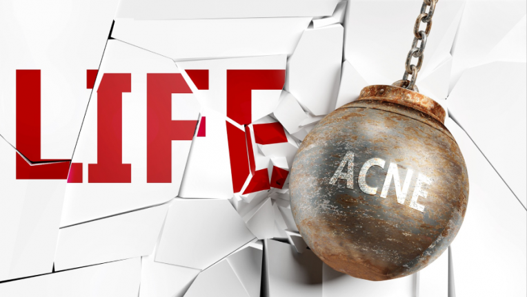 lo stress contribuisce all' aggravarsi dell' acne giovanile