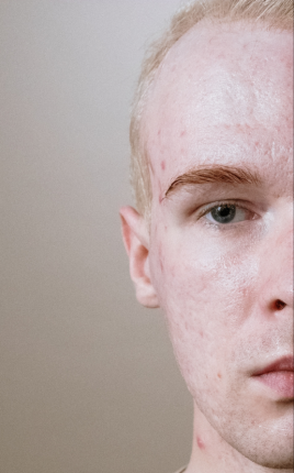 Le cicatrici sono una conseguenza frequente dell’acne