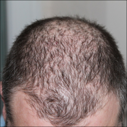 caduta dei capelli negli uomini è molto frequente
