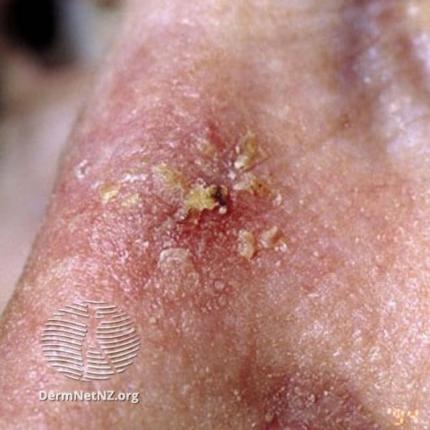 Cheratosi attiniche cause, diagnosi, trattamento e cura