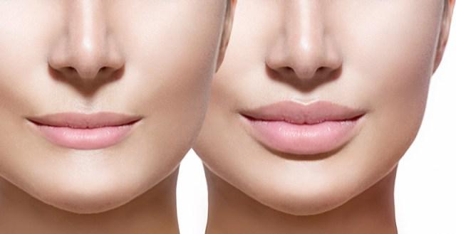 Filler labbra o botox? Conosci la differenza?