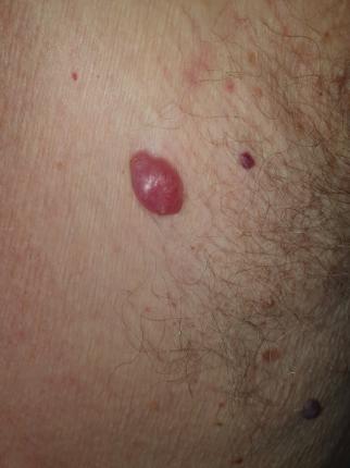 melanoma acromico