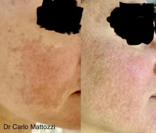 melasma viso