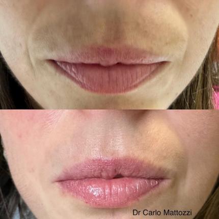 melasma labbra