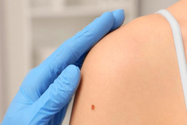 Melasma viso cos'è e come curarlo