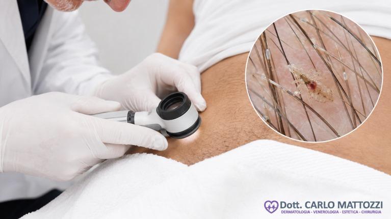 Pediculosi pubica, diagnosi, trattamento e cura Pediculosi pubica, diagnosi, trattamento e cura