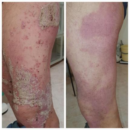 psoriasi gambe