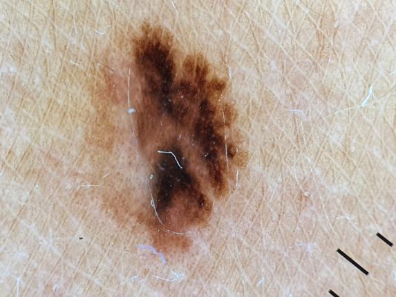 Quando e perché un neo si trasforma in melanoma