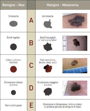 sintomi melanoma