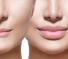 Filler labbra o botox? Conosci la differenza?