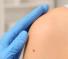 Melasma viso cos'è e come curarlo