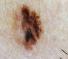 Quando e perché un neo si trasforma in melanoma