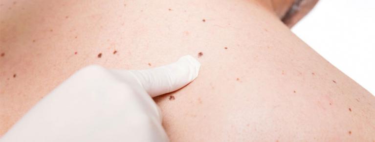Fare prevenzione con una prima visita dermatologica può essere vitale