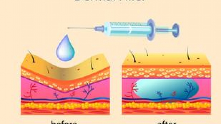 immagine 4 di Differenza tra BOTOX e FILLER