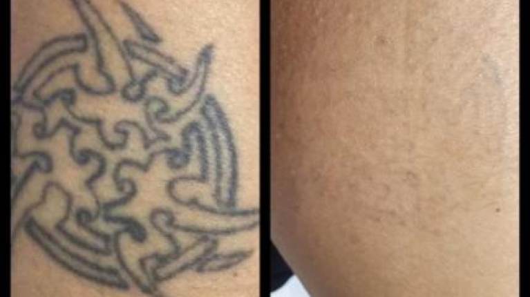immagine 9 di Come Rimuovere un Tatuaggio Permanente