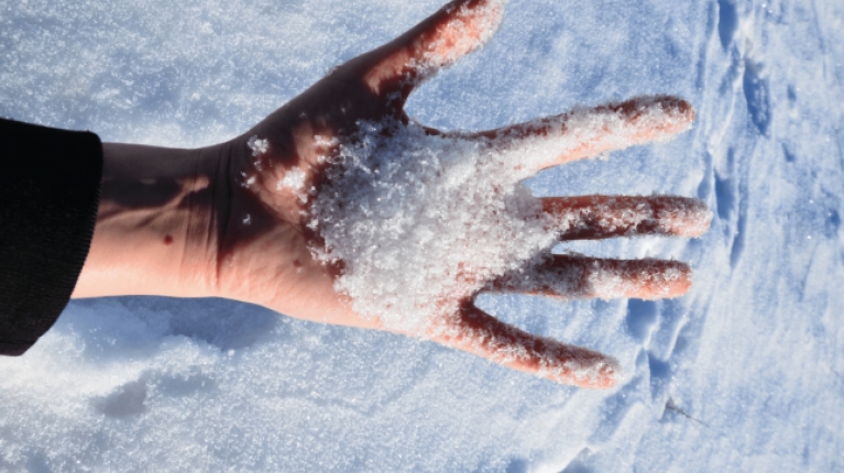 immagine 1 di Riconoscere la dermatite (eczema) da freddo e curarla