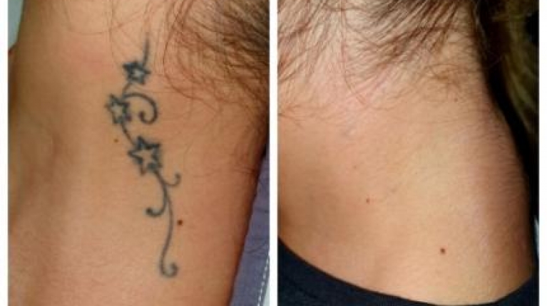 immagine 11 di Come Rimuovere un Tatuaggio Permanente