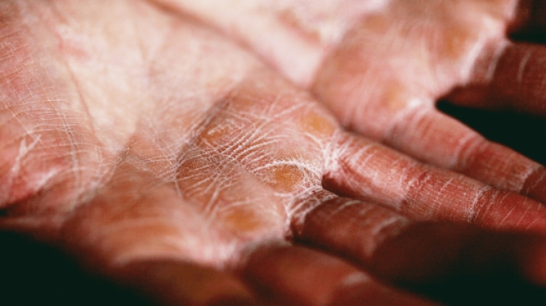 immagine 2 di Riconoscere la dermatite (eczema) da freddo e curarla