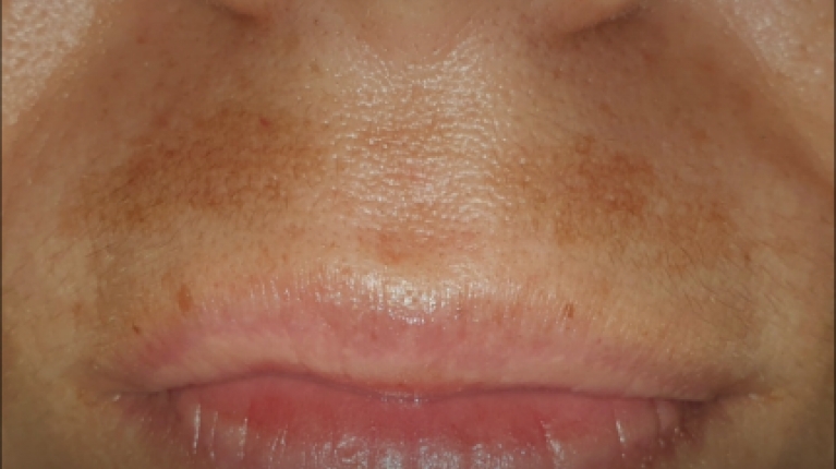 immagine 3 di Iperpigmentazione cause e rimedi contro le macchie scure sulla pelle