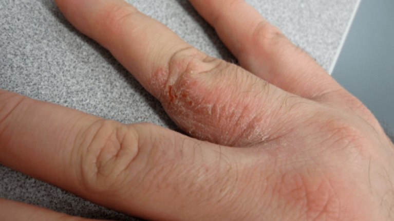 immagine 3 di Riconoscere la dermatite (eczema) da freddo e curarla