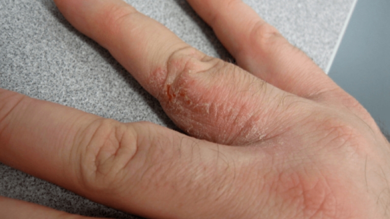 immagine 3 di Riconoscere la dermatite (eczema) da freddo e curarla