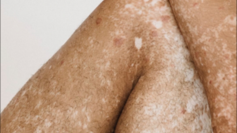 immagine 5 di Iperpigmentazione cause e rimedi contro le macchie scure sulla pelle