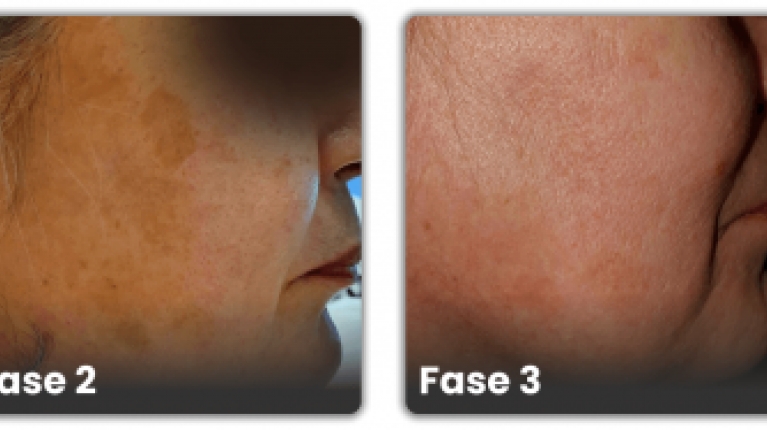 immagine 11 di Iperpigmentazione cause e rimedi contro le macchie scure sulla pelle