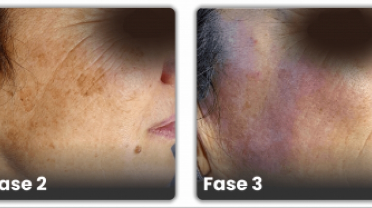 immagine 8 di Iperpigmentazione cause e rimedi contro le macchie scure sulla pelle