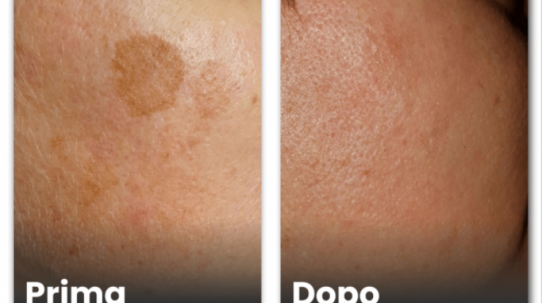 immagine 9 di Iperpigmentazione cause e rimedi contro le macchie scure sulla pelle