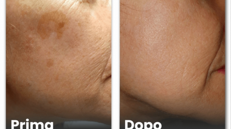 immagine 10 di Iperpigmentazione cause e rimedi contro le macchie scure sulla pelle