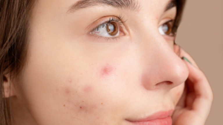 immagine 1 di Acne Giovanile e come curarla