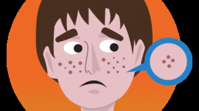 immagine 2 di Acne Giovanile e come curarla