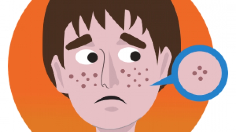 immagine 12 di Acne Giovanile e come curarla