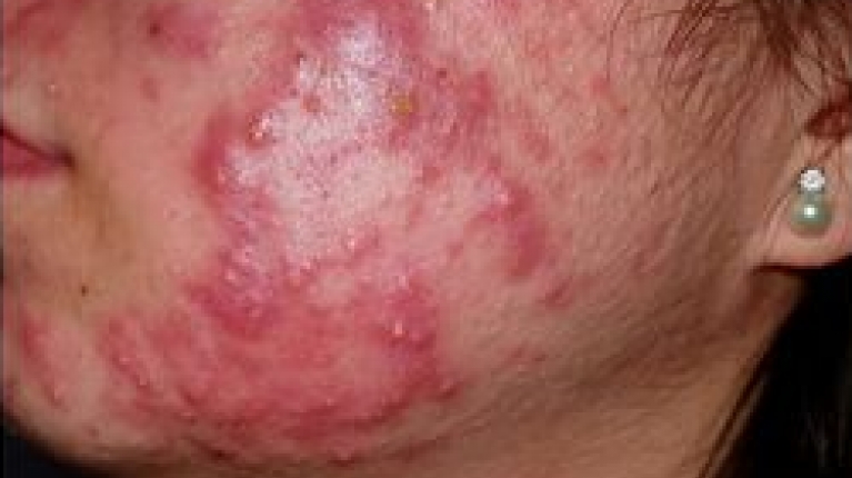 immagine 3 di Acne Giovanile e come curarla