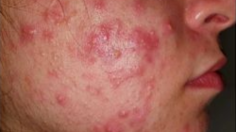immagine 4 di Acne Giovanile e come curarla