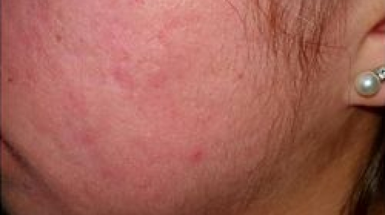 immagine 5 di Acne Giovanile e come curarla